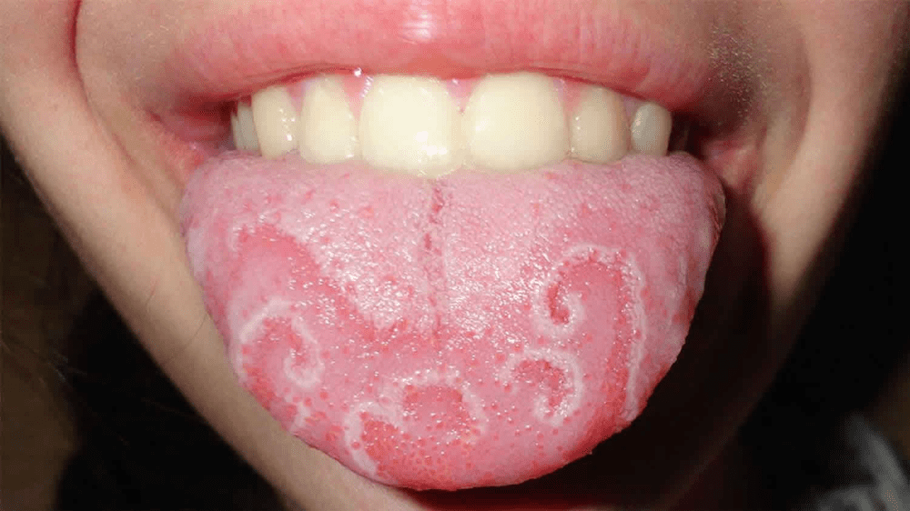 Viêm lưỡi khiến lưỡi thay đổi màu sắc