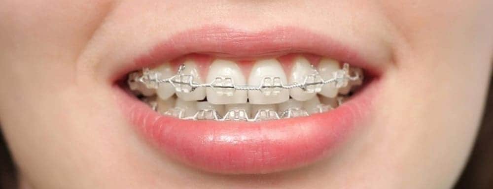 niềng răng có thể khiến lưỡi bị viêm