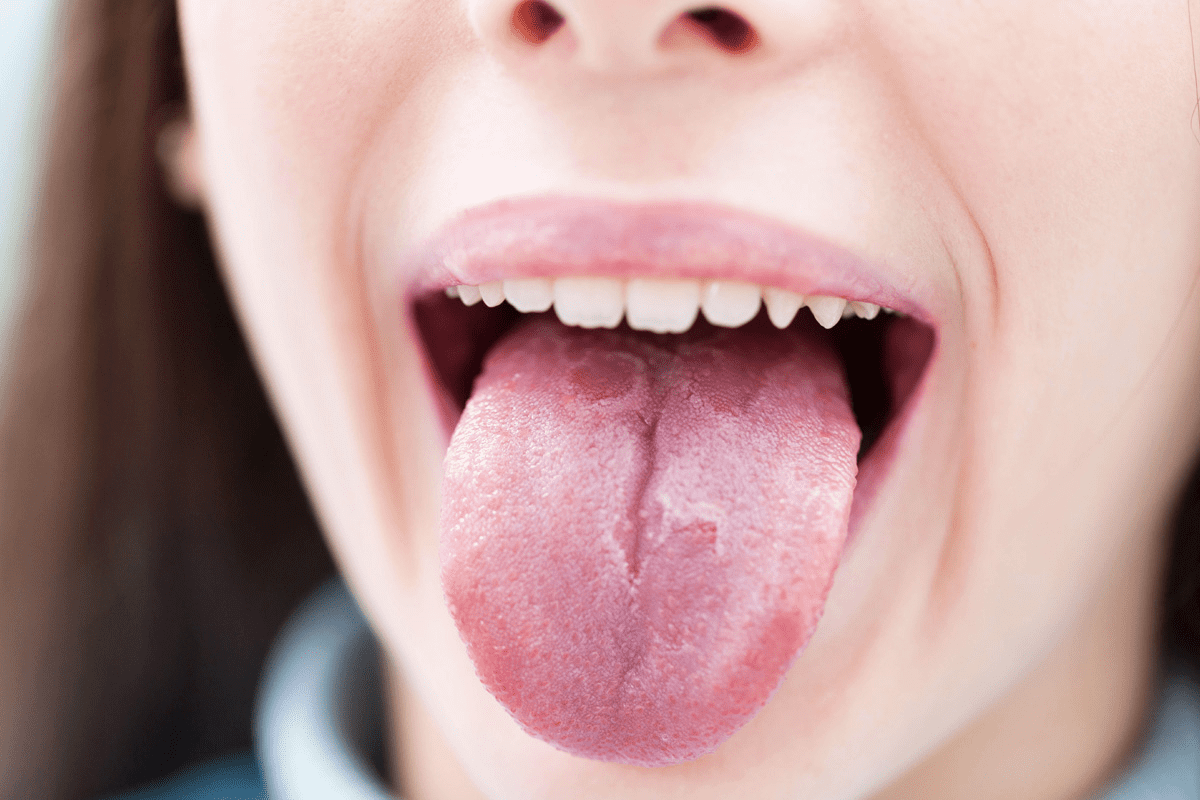 Nguyên nhân và cách điều trị nhiệt lưỡi đau họng - colgate