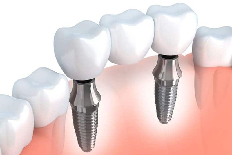 Cầu răng sứ trên trụ Implant