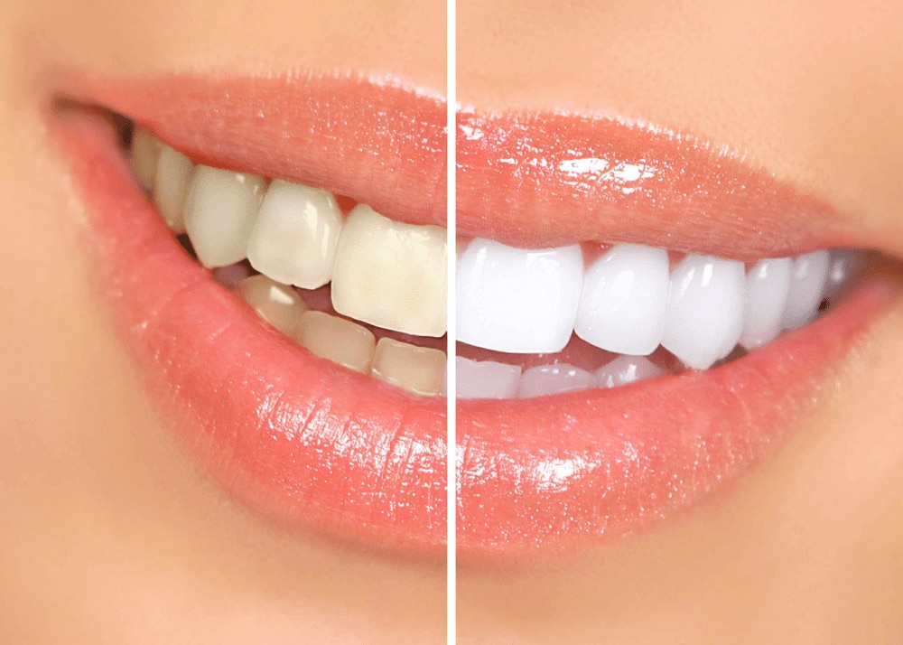Tẩy trắng răng giúp bạn sở hữu nụ cười tự tin
