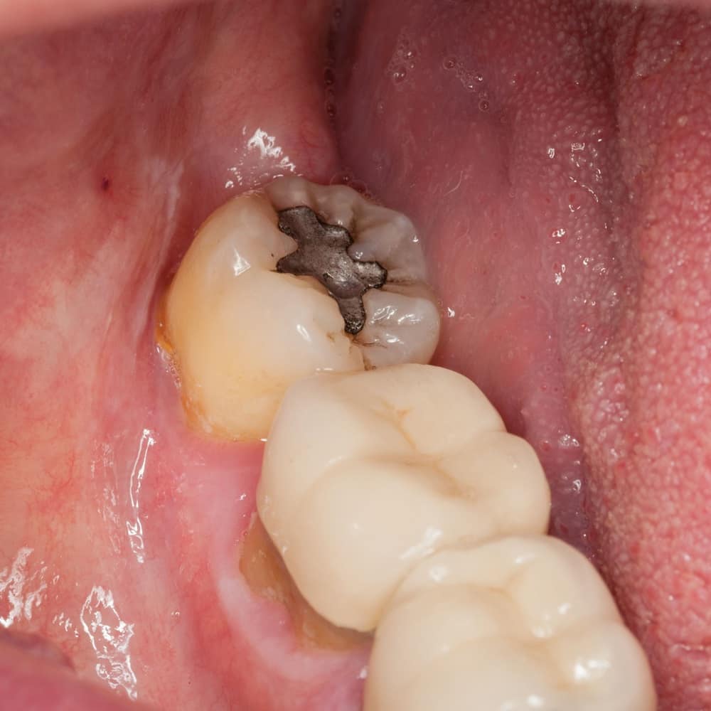Điều trị răng khôn bị sâu nhẹ bằng phương pháp trám răng