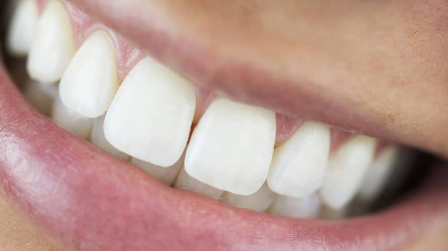cách ngăn ngừa sâu răng - colgate