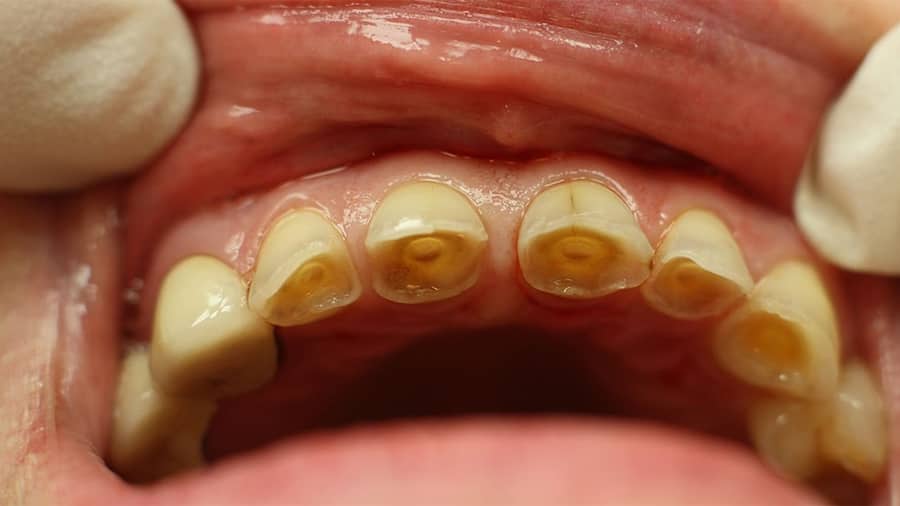 nguyên nhân gây ra xói mòn và ăn mòn răng? - colgate