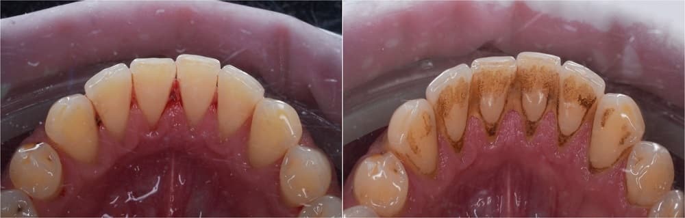 Sự khác biệt của răng và nướu sau khi cạo vôi răng