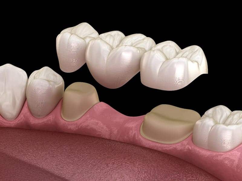 Cầu răng sứ là giải pháp phục hình răng bị mất bằng cách bắc cầu