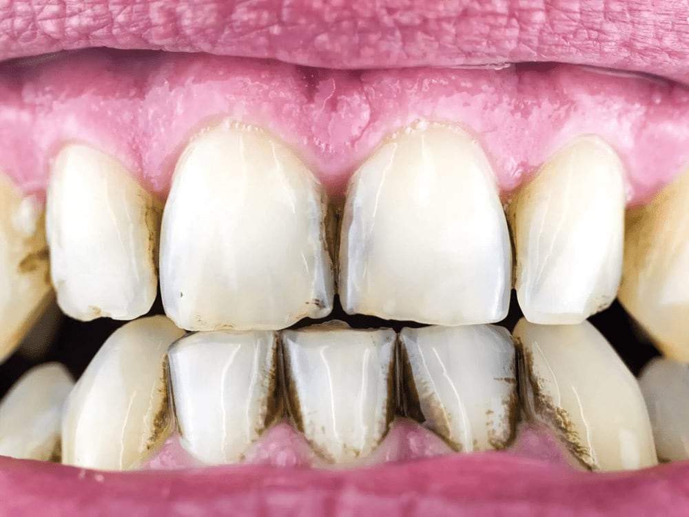 Nguyên nhân răng bị mảng bám đen