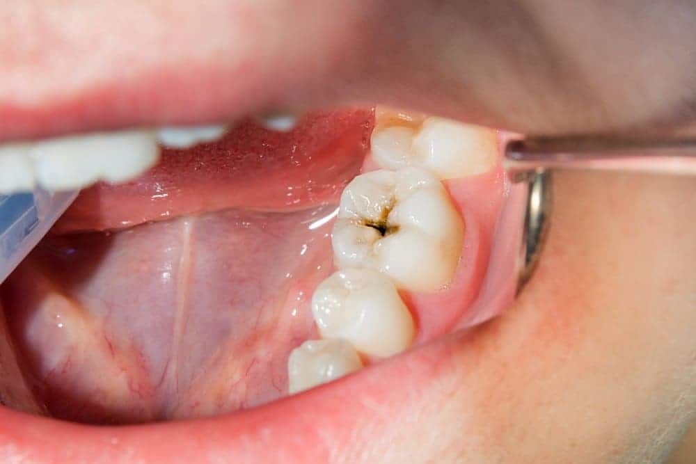 Sâu răng độ 1 (mức độ nhẹ)