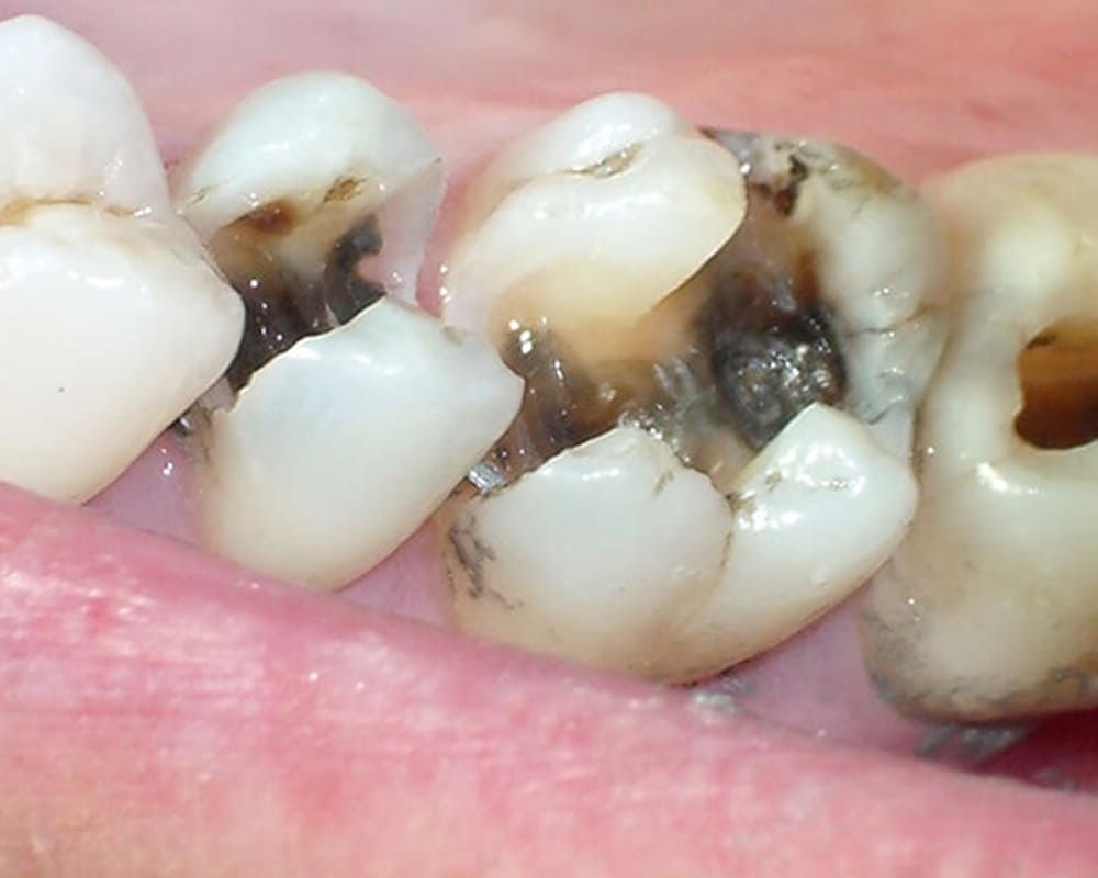 Sâu răng mức độ 2 (sâu ăn vào tủy)