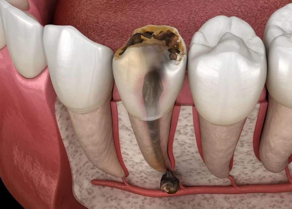 Sâu răng mức độ 3 (viêm nhiễm tủy răng)