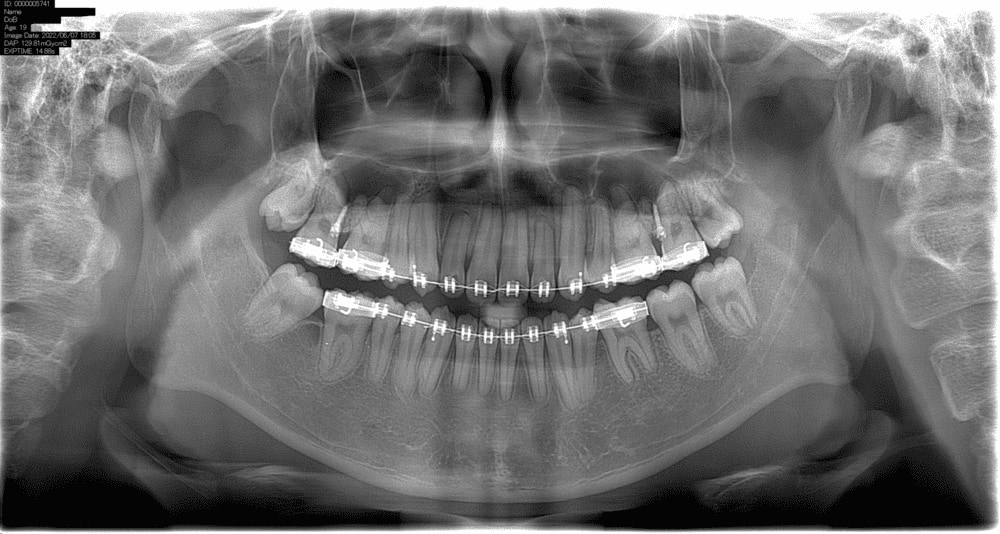 Chụp X-quang vòng quanh răng