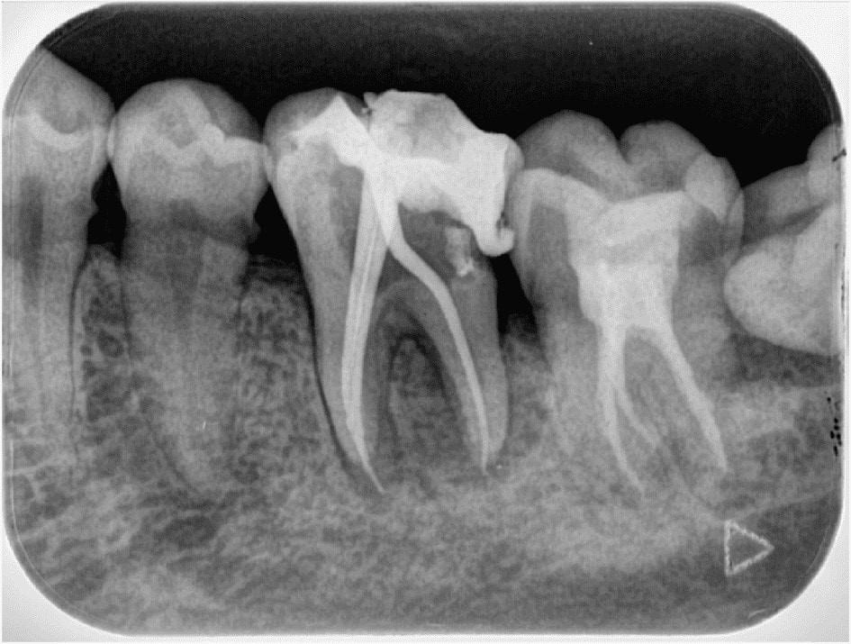 Chụp X-quang răng quanh chóp để phát hiện u nang, mụn nhọt,...