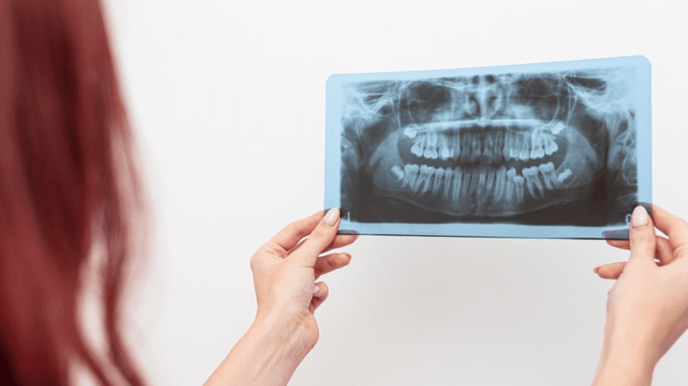 Chụp X-quang răng không cần kiêng ăn uống
