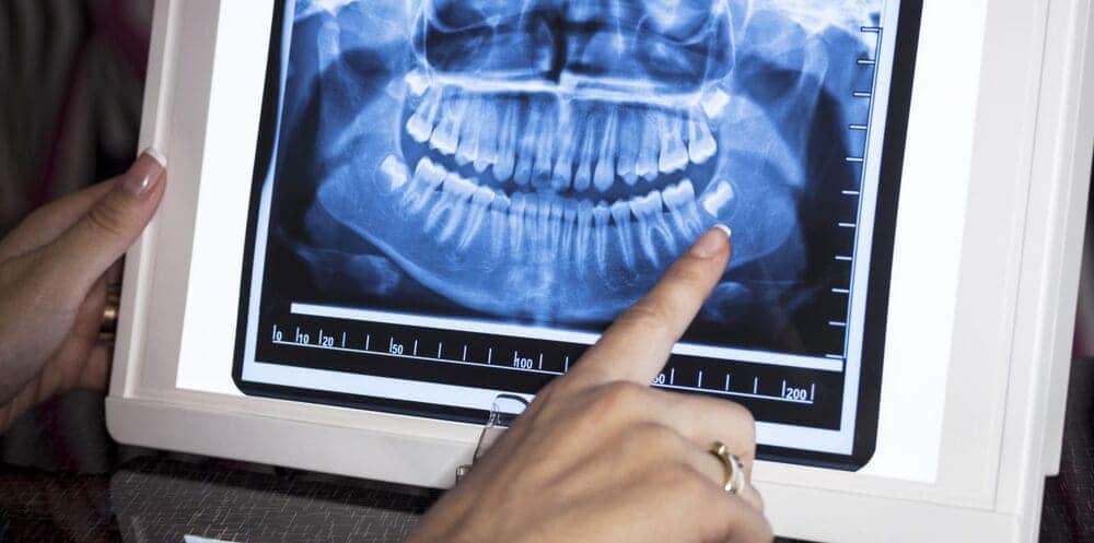 Chụp X-quang răng ở trẻ em để kiểm tra tình trạng mọc răng