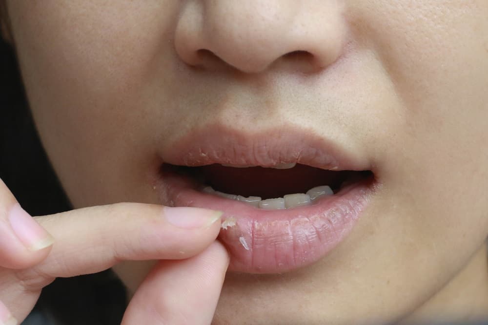 Dấu hiệu dị ứng kem đánh răng: môi khô, nứt nẻ, sưng môi