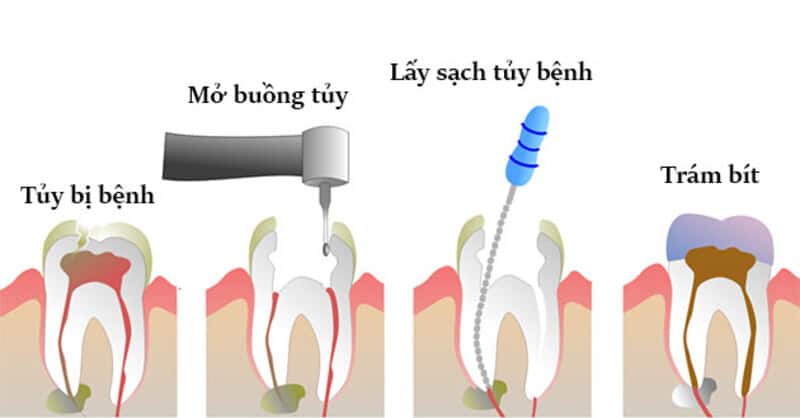 Lấy tủy răng là cách trị sâu răng phù hợp cho trường hợp sâu nặng