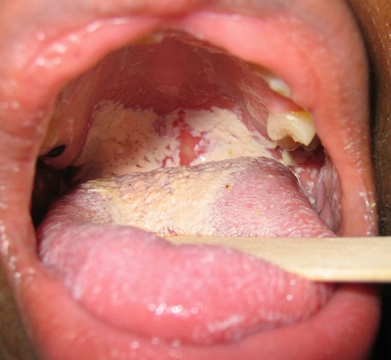  Bệnh nấm miệng ở trẻ