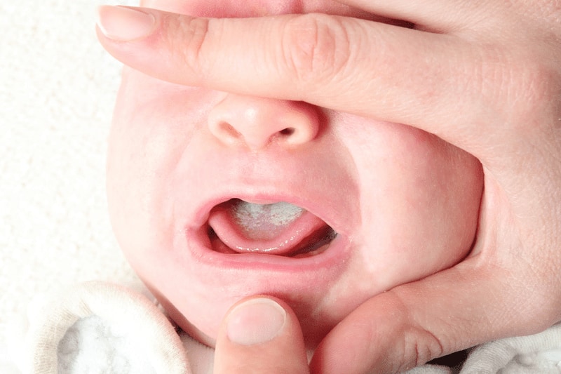 Trẻ sơ sinh bị tưa lưỡi thường quấy khóc
