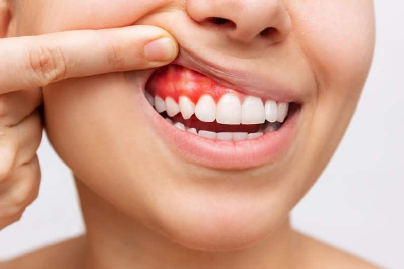 Áp xe răng có thể dẫn đến mất răng
