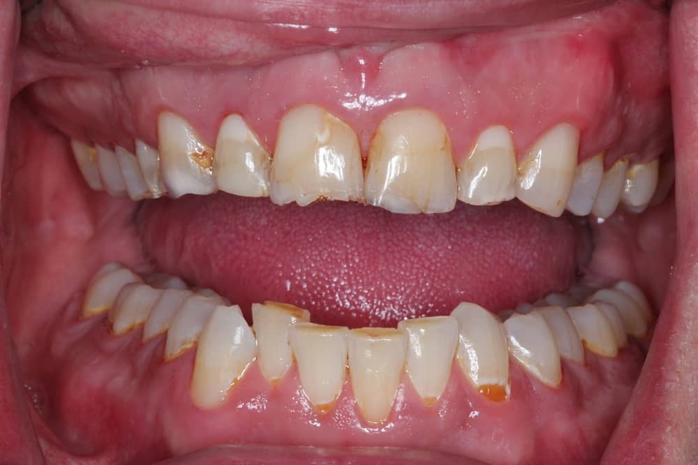 Mòn răng là tình trạng mất đi lớp men răng bên ngoài