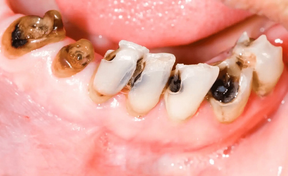 sâu răng khiến răng nhạy cảm, dễ ê buốt khi ăn đồ nóng lạnh