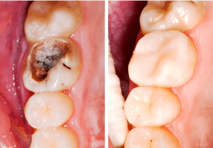Cách điều trị sâu răng như thế nào?
