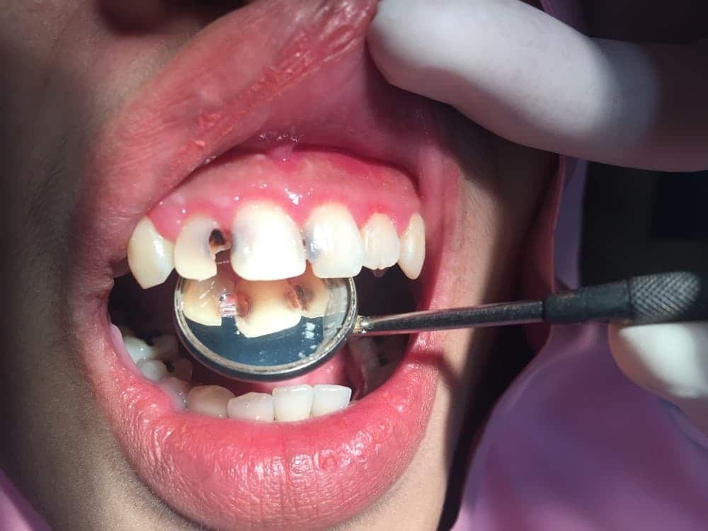 răng cửa bị sâu có thể xuất phát từ nhiều nguyên nhân 