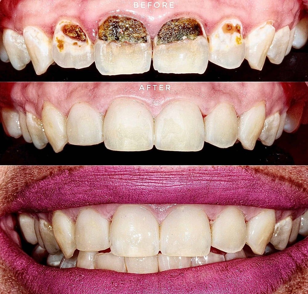 Nguyên nhân và cách chữa trị răng cửa bị sâu